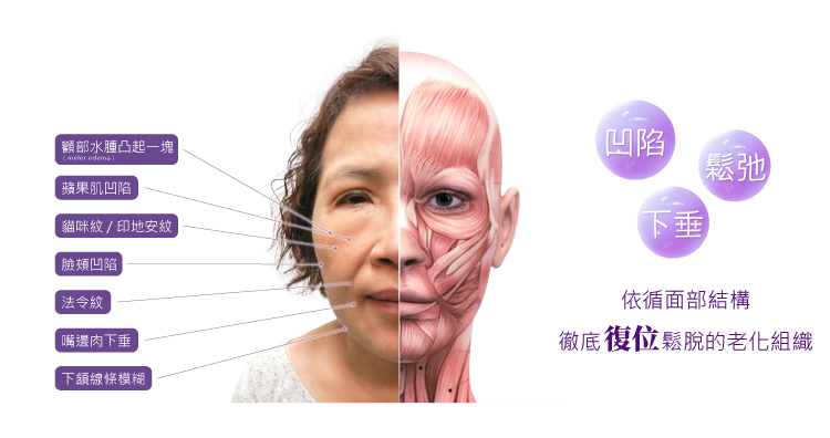 凹陷、鬆弛、下垂，依循面部結構徹底復位鬆脫的老化組織,顴部水腫凸起一塊,蘋果肌凹陷,貓咪紋/印地安紋,臉頰凹陷,嘴邊肉下垂,下頷線條模糊
