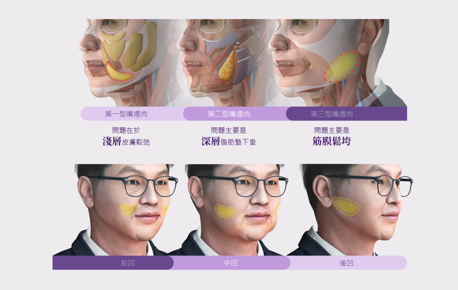 老化產生的三型嘴邊肉、三型凹陷與骨凸問題