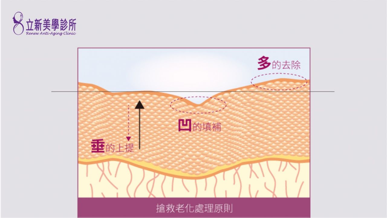 立新搶救老化三原則：（1）垂的上提（2）凹的填補（3）多的去除