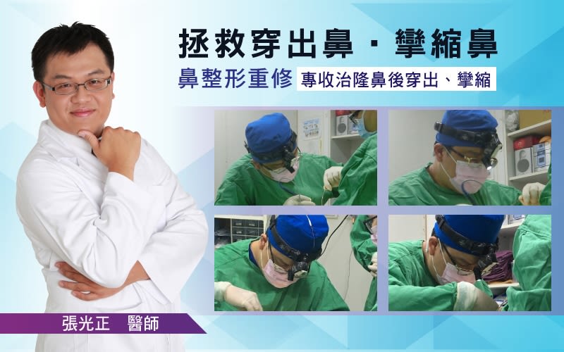 驚！越南正妹美的鼻要鼻要～凹洞鼻神再造黃金「鼻」例,手術,隆鼻,立新美學診所