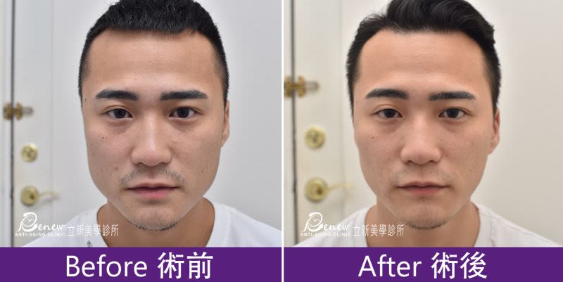 德國新一代肉毒除咀嚼肌