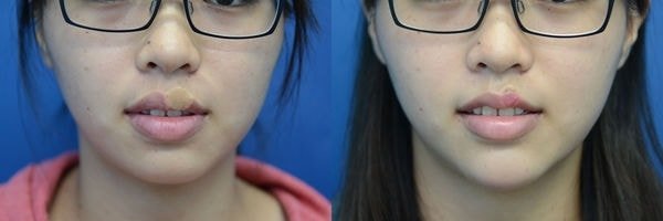 【縮唇/3D俏唇珠】醜唇形怎麼辦? 謝氏縮唇終結它!，立新美學診所(對比圖)