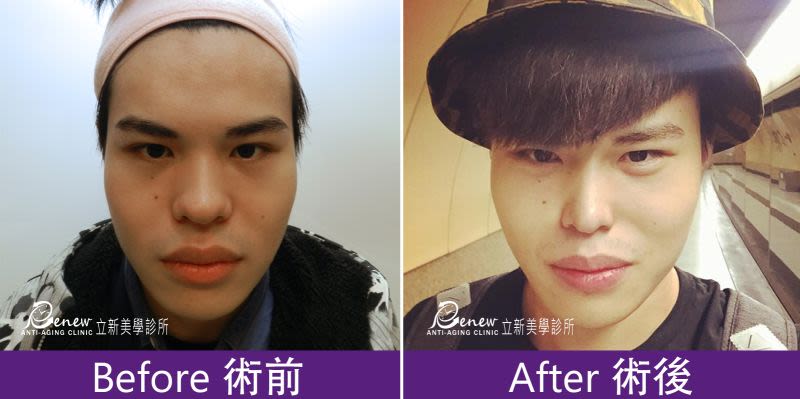 Q鼻+安全可吸收材質撐架