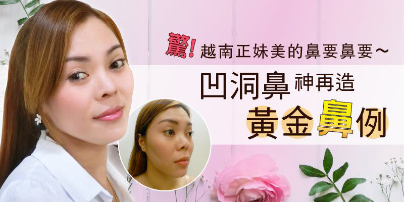 【穿出鼻、攣縮鼻重建】驚!越南正妹美的鼻要鼻要~凹洞鼻神再造黃金「鼻」例