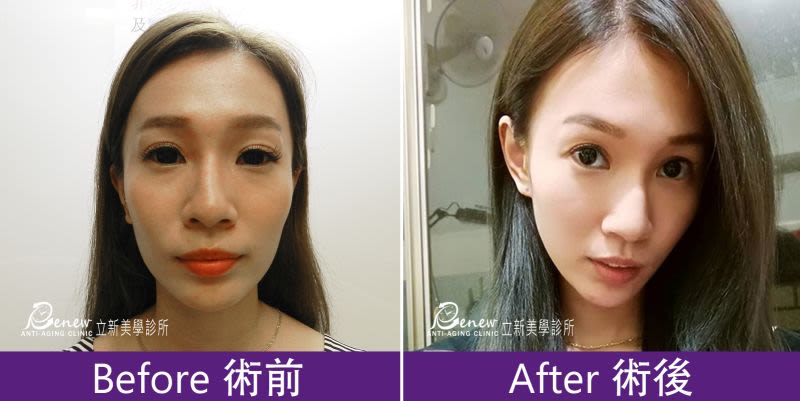 豐太陽穴
