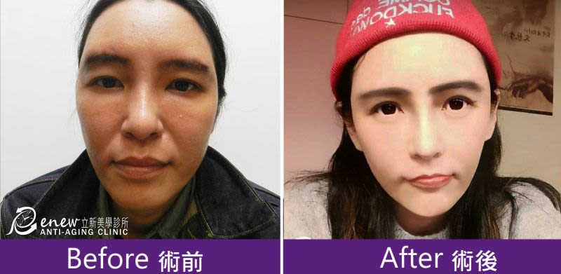 訂製化法令紋假體