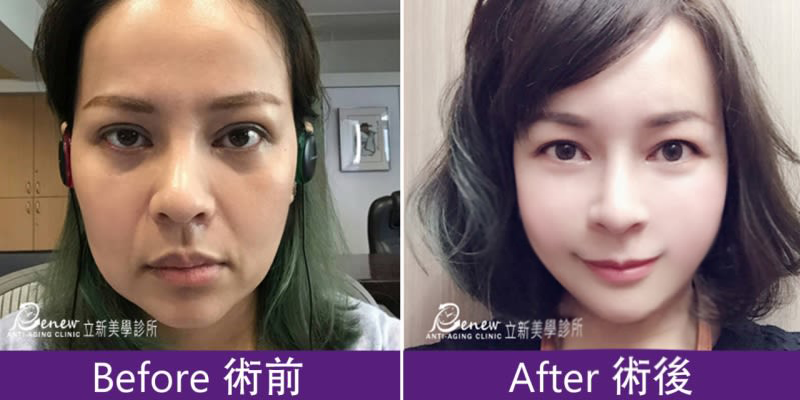耳廓短痕三層次緊顏拉皮
