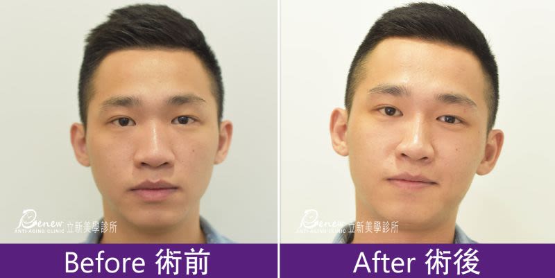 Q鼻+安全可吸收材質撐架