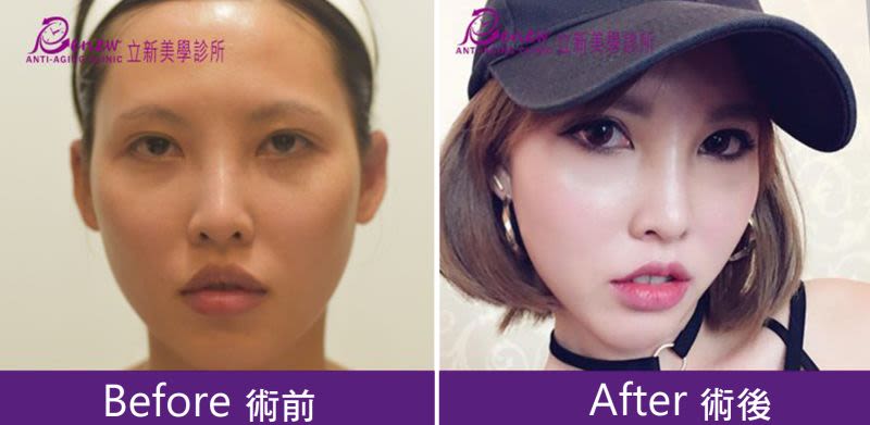 縮唇、微笑嘴角、唇珠雕塑