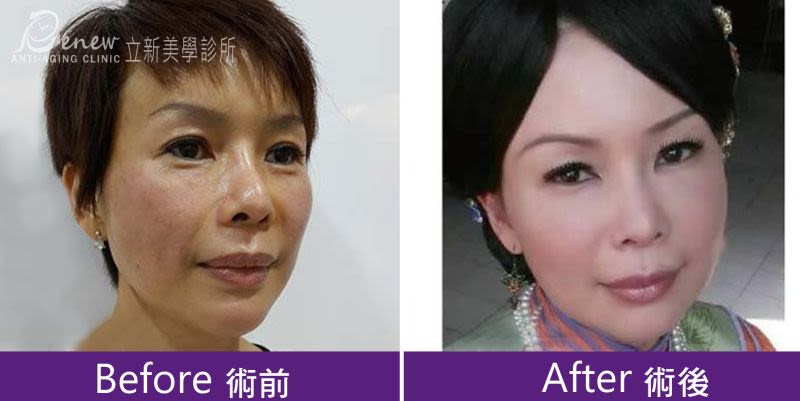 強升8字&強升8字網狀
