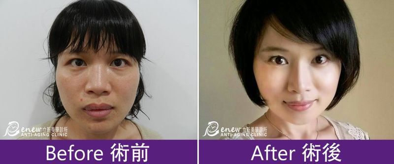 舒顏萃聚左旋乳酸(俗稱童妍針)