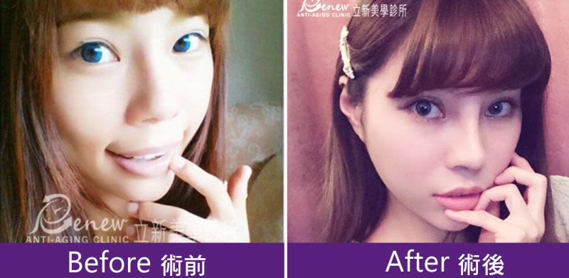 Q鼻+安全可吸收材質撐架
