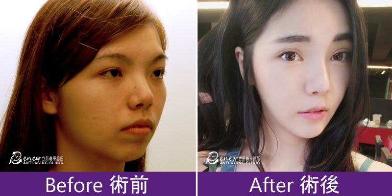 Q下巴+安全可吸收材質撐架