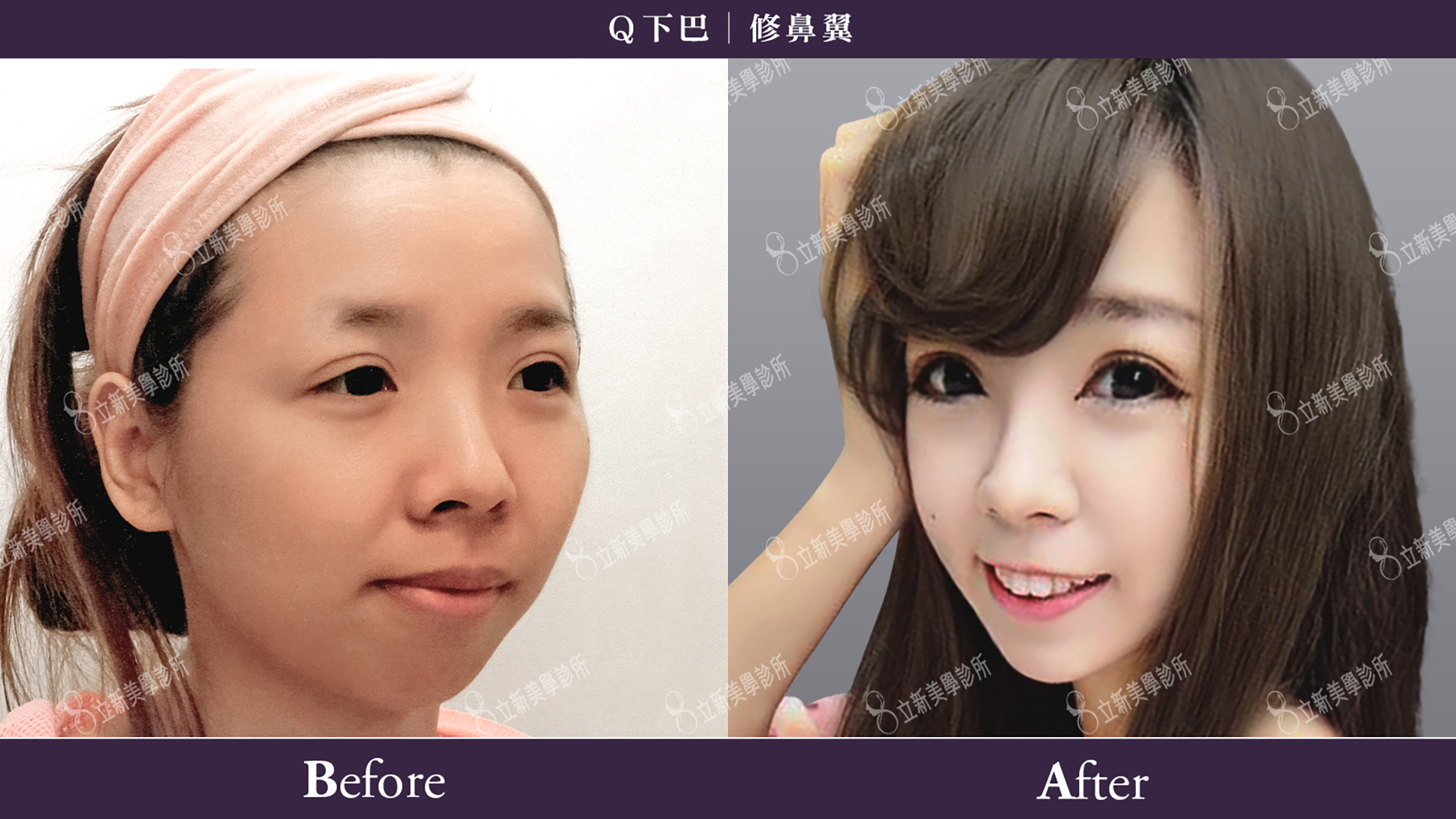 Q下巴+安全可吸收材質撐架
