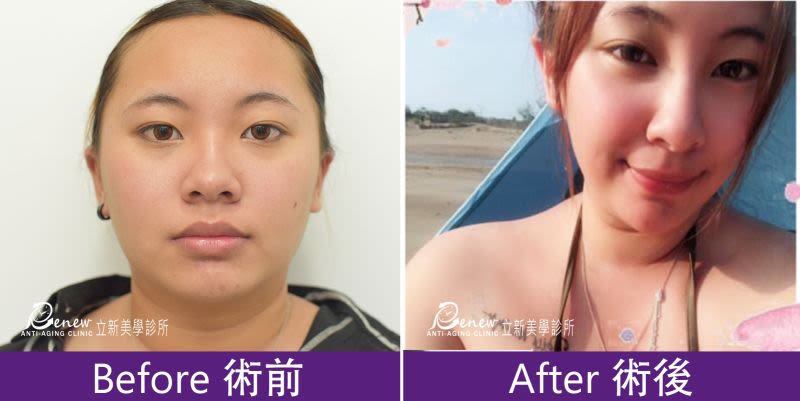 Q鼻+安全可吸收材質撐架
