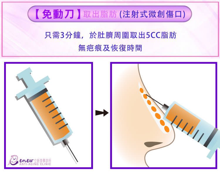 驚！越南正妹美的鼻要鼻要～凹洞鼻神再造黃金「鼻」例,手術,隆鼻,立新美學診所,免動刀,取出脂肪,注射式微創傷口,只需3分鐘,於肚臍周圍取出5CC脂肪,無疤痕及恢復時間