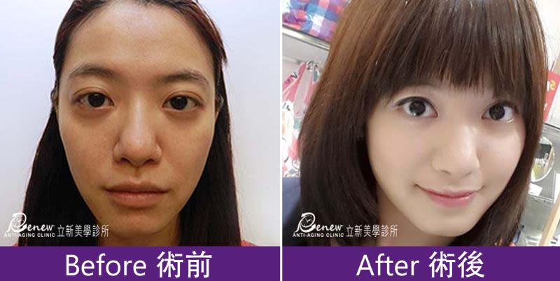 黑眼圈、淚溝
