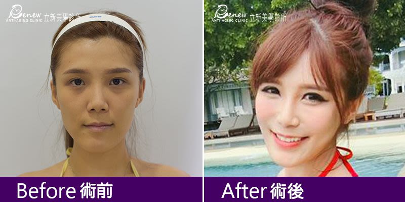 Q鼻+安全可吸收材質撐架