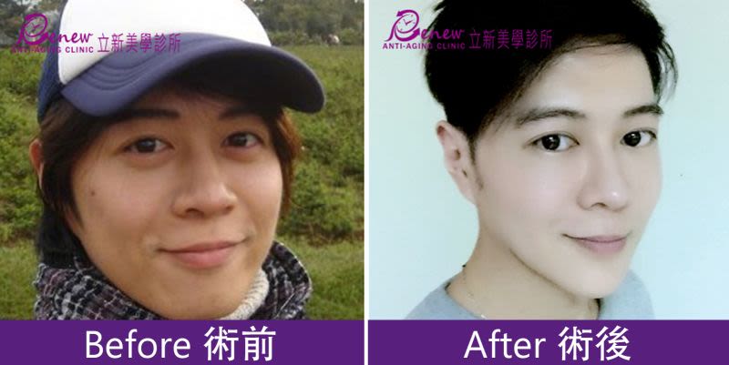 強升8字&強升8字網狀