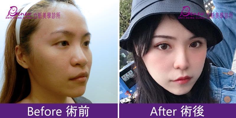 Q鼻+安全可吸收材質撐架