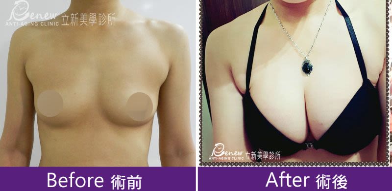 自體脂肪隆乳