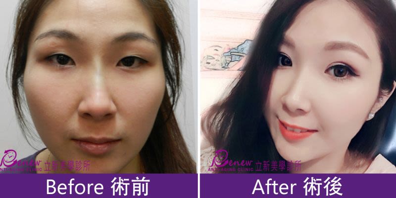 雙眼皮
