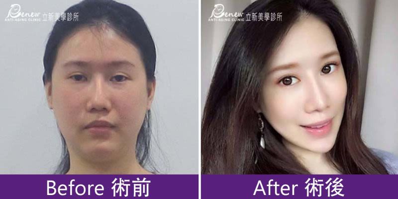 強升8字&強升8字網狀