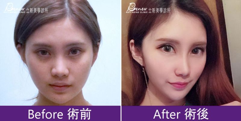 舒顏萃聚左旋乳酸(俗稱童妍針)