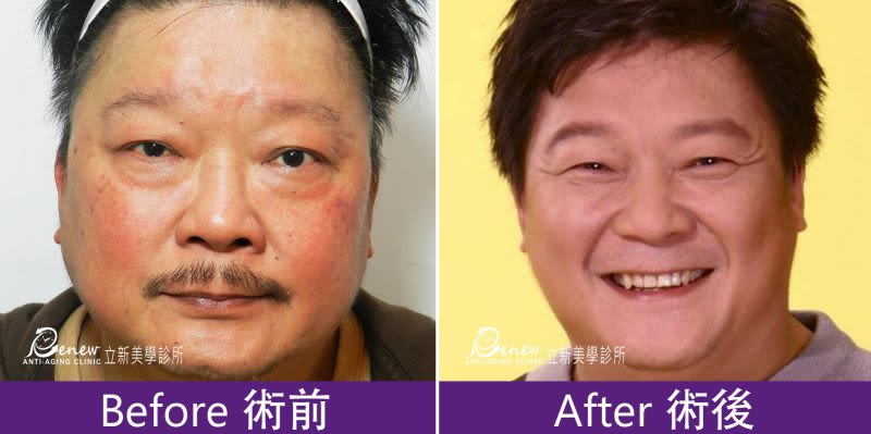 除眼袋
