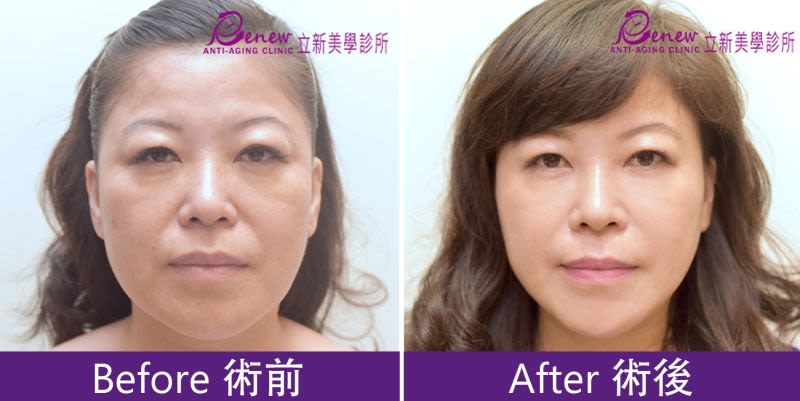 德國新一代肉毒除咀嚼肌
