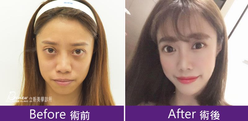 Q鼻+安全可吸收材質撐架