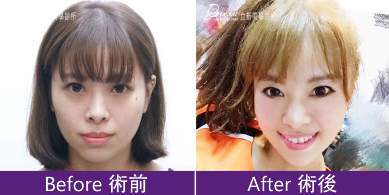 黑眼圈、淚溝