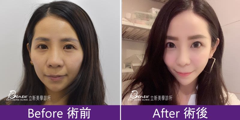 Q鼻+安全可吸收材質撐架