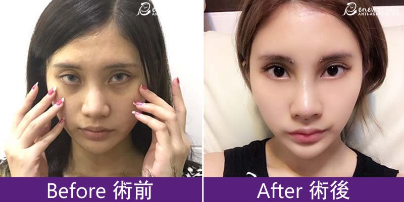 黑眼圈、淚溝