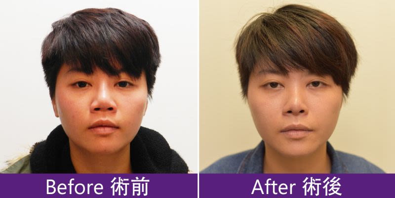 穿出鼻、攣縮鼻重建