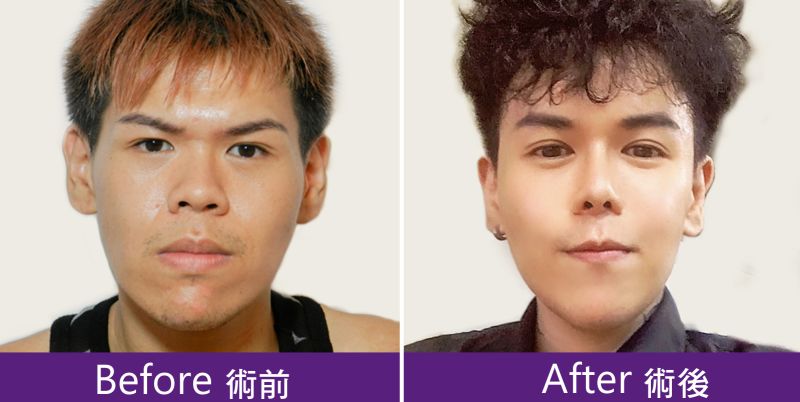 訂製化法令紋假體