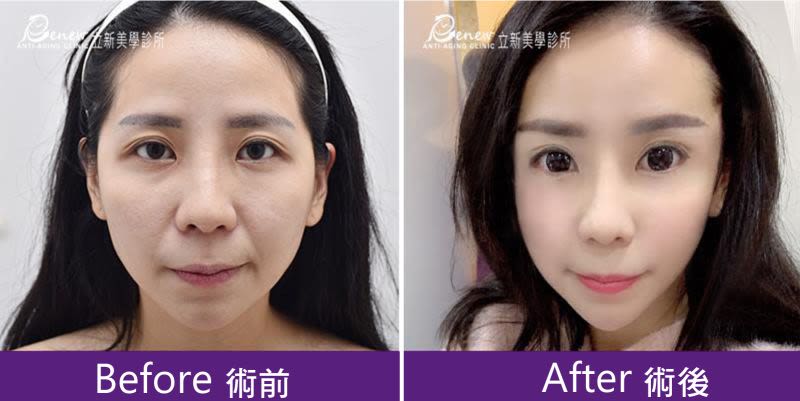 隱痕提眉眼尾