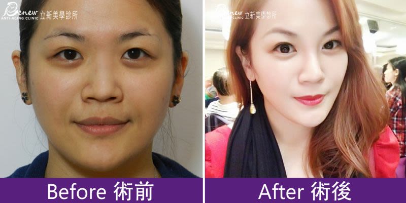Q鼻+安全可吸收材質撐架