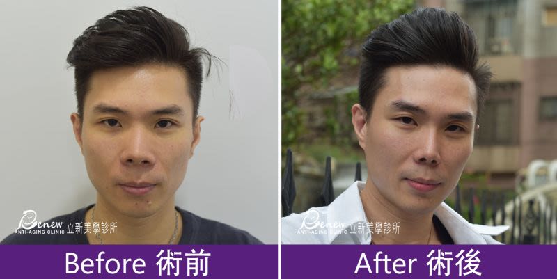Q鼻+安全可吸收材質撐架