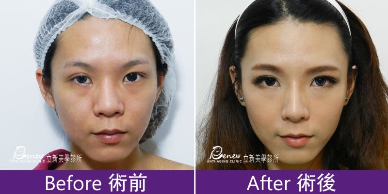 Q鼻+安全可吸收材質撐架