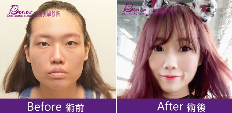 Q下巴+安全可吸收材質撐架