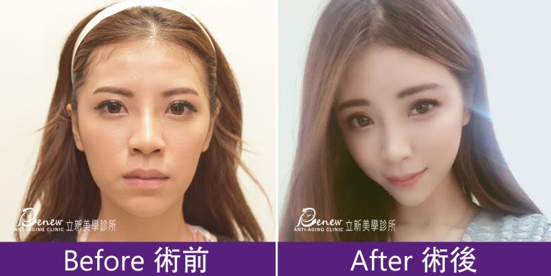 豐太陽穴