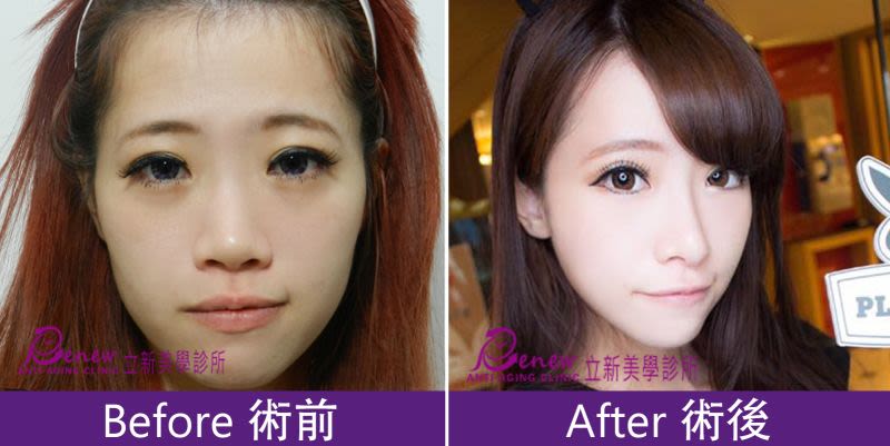 修鼻翼