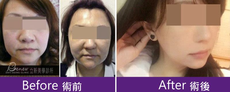 強升8字&強升8字網狀