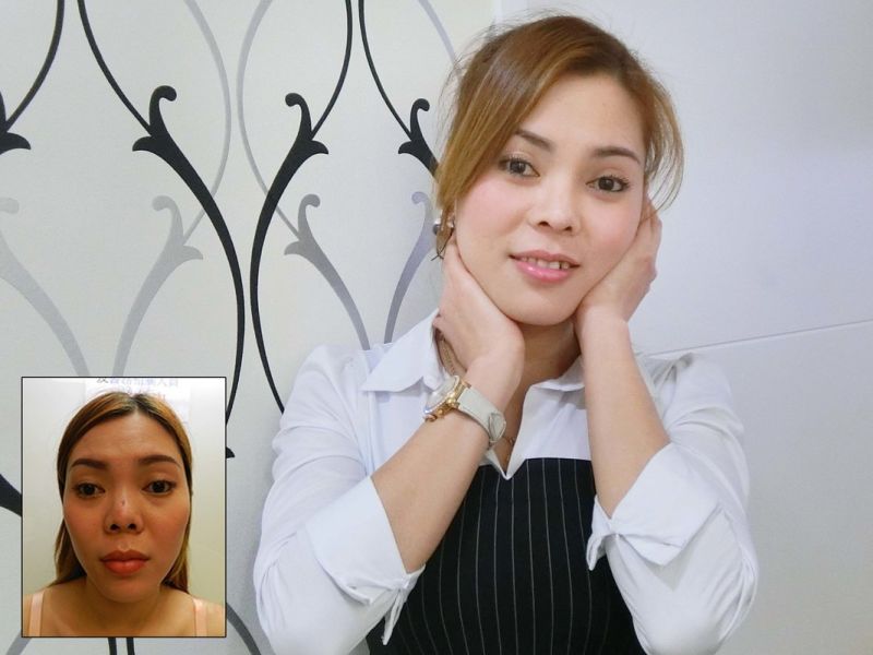 (對比圖)驚！越南正妹美的鼻要鼻要～凹洞鼻神再造黃金「鼻」例,手術,隆鼻,立新美學診所,免動刀