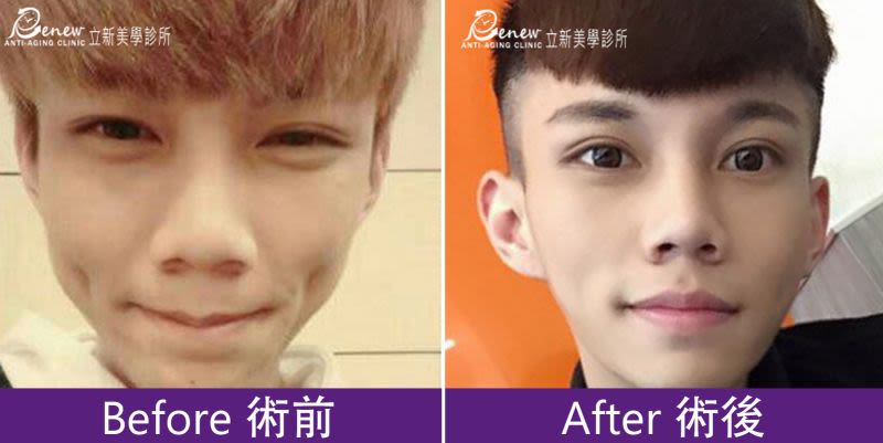 修鼻頭、縮鼻翼