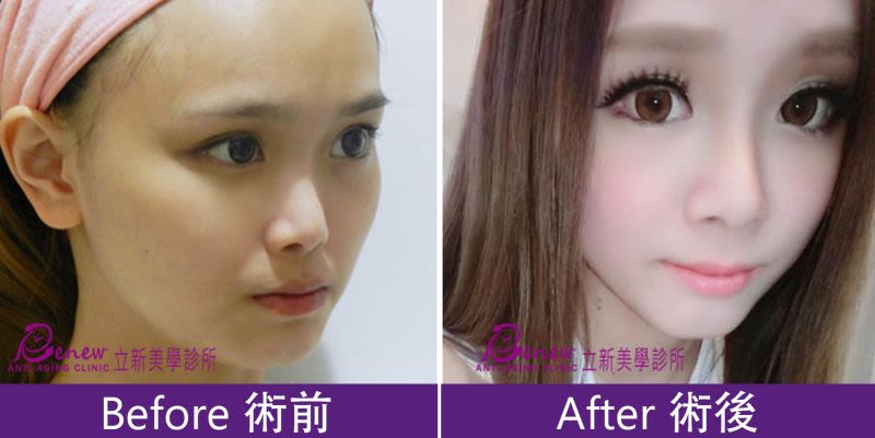 Q鼻+安全可吸收材質撐架