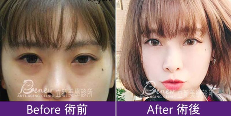 舒顏萃聚左旋乳酸(俗稱童妍針)