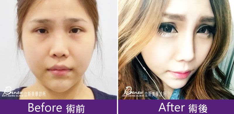 Q鼻+安全可吸收材質撐架