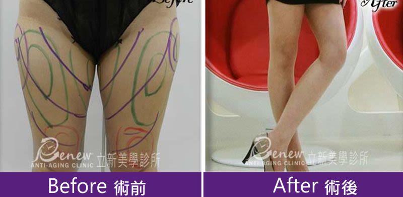 複合式抽脂精雕